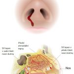 Časté krvácení z nosu (epistaxe) – příčiny & léčba – jak řešit?