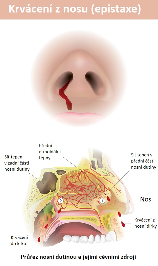 Krvácení z nosu (epistaxe) - ilustrace