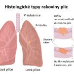 Nemalobuněčný karcinom plic – příznaky, příčiny a léčba