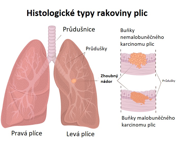 Histologické typy rakoviny plic - ilustrace