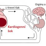 Kardiogenní šok – když srdce není schopno dostatečně pumpovat krev do těla – příznaky, příčiny a léčba