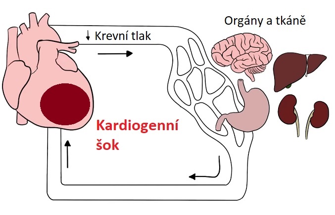  Kardiogenní šok je život ohrožující stav, kdy srdce není schopno efektivně pumpovat krev do těla, což vede k nedostatečnému okysličení tkání a orgánů. Tento stav často vzniká v důsledku závažných srdečních problémů.