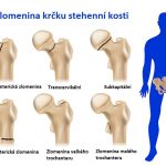 Zlomenina v krčku stehenní kosti – co s ní? Příznaky, příčiny a léčba