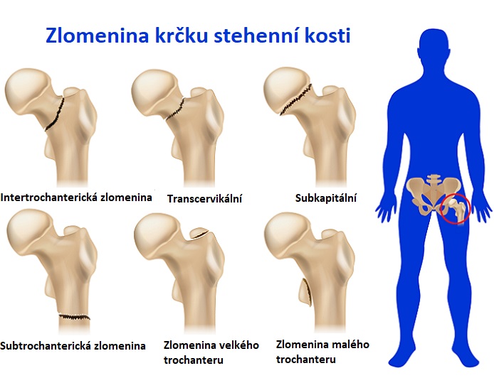 Zlomenina krčku stehenní kosti