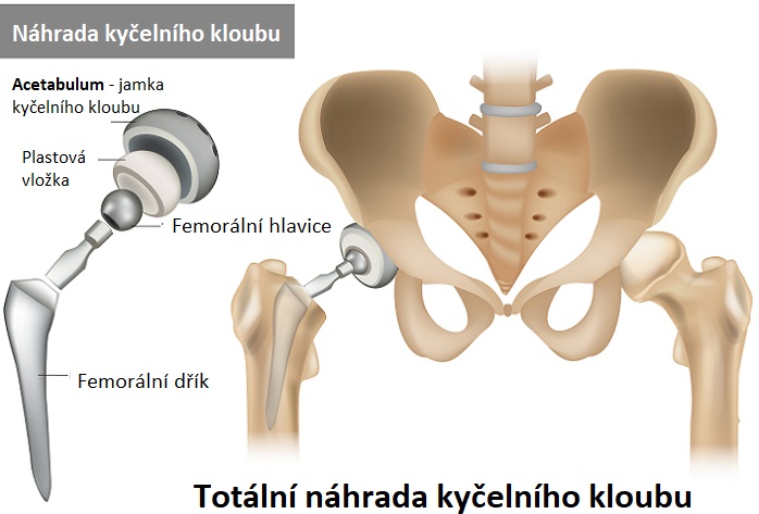 Náhrada kyčelního kloubu