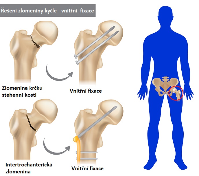 Takto může vypadat vnitřní fixace po zlomenině v krčku stehenní kosti