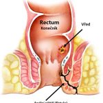 Anální píštěl (fistula) – propojení mezi vnitřní částí konečníku a povrchem kůže kolem řitního otvoru – příznaky, příčiny a léčba