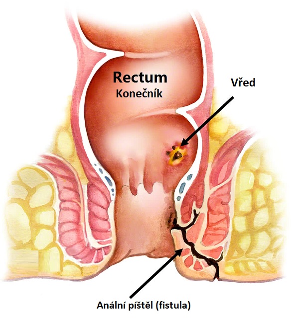 Anální píštěl je abnormální spojení (průchod) mezi análním kanálem (nebo konečníkem) a kůží v oblasti kolem konečníku.