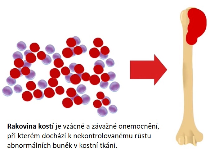 Jako u jiných druhů rakoviny, kostní nádory se tvoří, když problémy s buněčnou DNA způsobí, že buňky rostou mimo kontrolu.