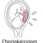 Choriokarcinom – zhoubný nádor trofoblastu – příznaky, příčiny a léčba