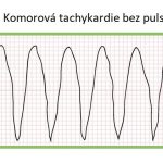 Komorová tachykardie bez pulsu – závažná srdeční arytmie – příznaky, příčiny a léčba