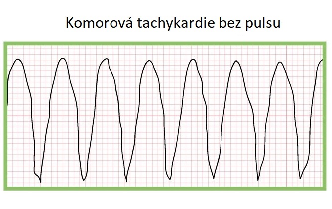 Komorová tachykardie bez pulsu