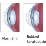 Bulózní keratopatie – příznaky, příčiny a léčba