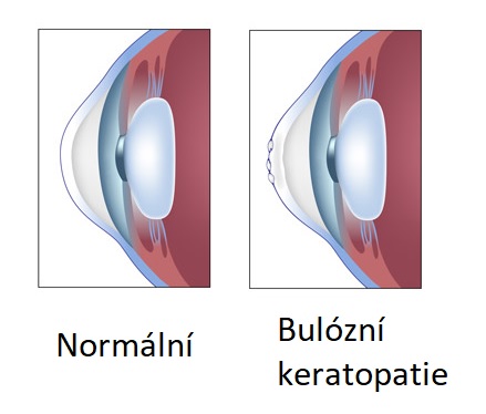 Bulózní keratopatie - ilustrace