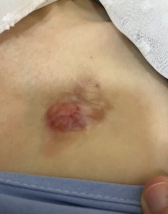 Takto může vypadat dermatofibrosarcoma protuberans