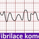 Fibrilace komor (ventrikulární fibrilace) – život ohrožující porucha srdečního rytmu – příznaky, příčiny a léčba