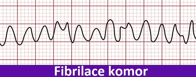 Fibrilace komor - život ohrožující porucha srdečního rytmu