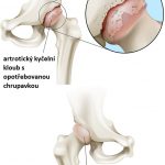 Osteoartróza kyčelního kloubu – příznaky, příčiny a léčba