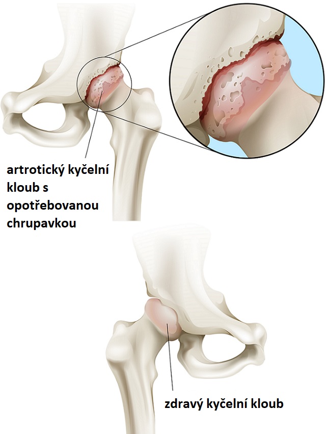 Osteoartróza kyčelního kloubu - ilustrace