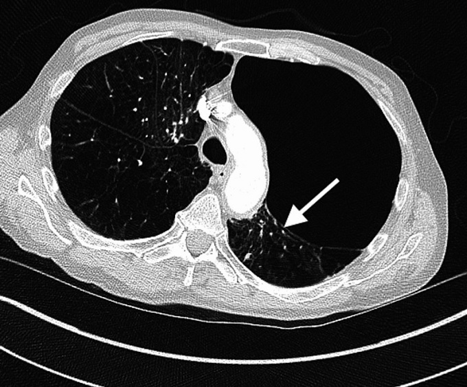 CT ukazující závažné oboustranné emfyzematózní změny s obří dutinou