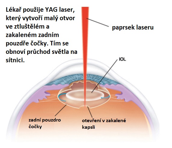 Laserová kapsulotomie oka - ilustrace