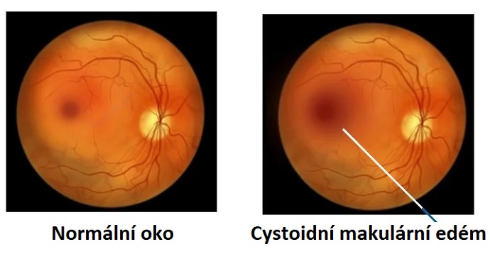 Cystoidní makulární edém je oční onemocnění, které postihuje část vaší sítnice. Nastává tehdy, když makula oteče a vytvoří se drobné puchýřky tekutiny, které vypadají jako malé cysty.