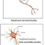 Optická neuritida (zánět optického nervu) – příznaky, příčiny a léčba