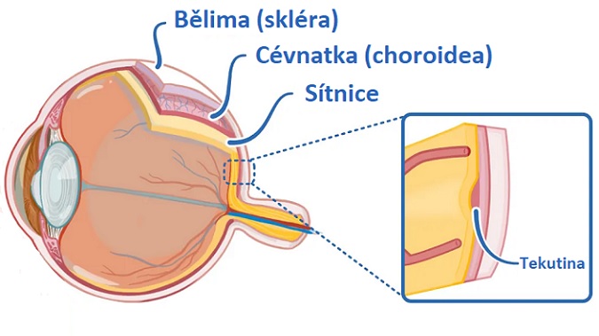 Centrální serózní retinopatie - ilustrace