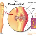 Káva a dna – může se při dně pít káva?