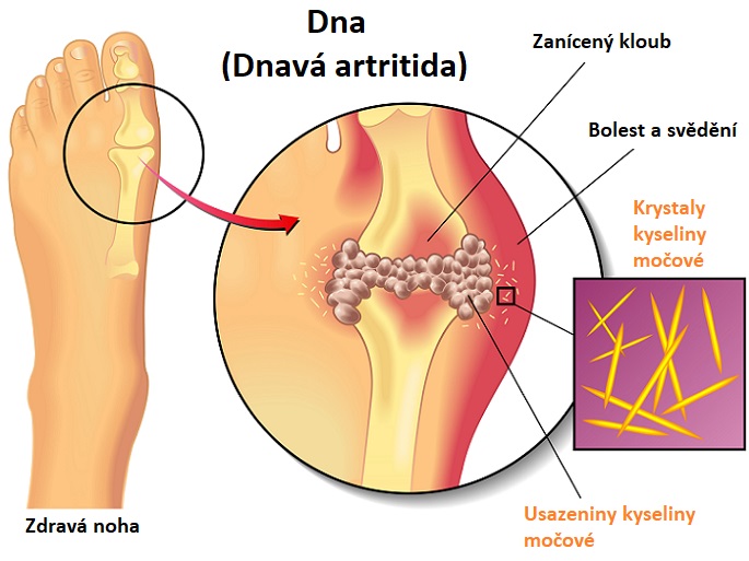 Dna (odborně arthritis urica) je metabolické onemocnění, které vzniká v důsledku hromadění kyseliny močové v těle.