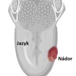 Rakovina jazyka – příznaky, příčiny a léčba