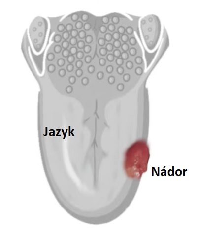 Rakovina jazyka je zhoubné nádorové onemocnění postihující buňky jazyka.